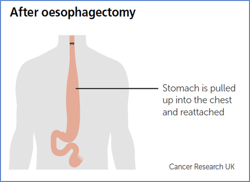 After Oesophagectomy