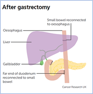After gastrectomy