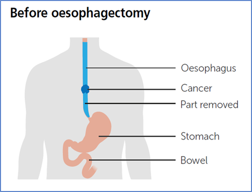 Before Oesophagectomy