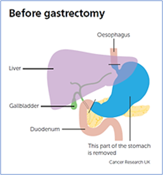 Before gastrectomy