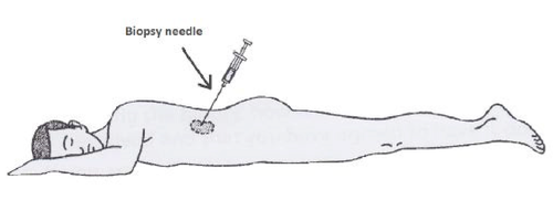 Biopsy Needle