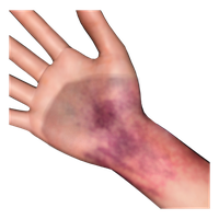 A close-up photo of a hand and wrist with a significant dark purple and red bruise.