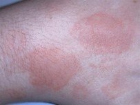 Close up image of the lesion or worst area of the rash