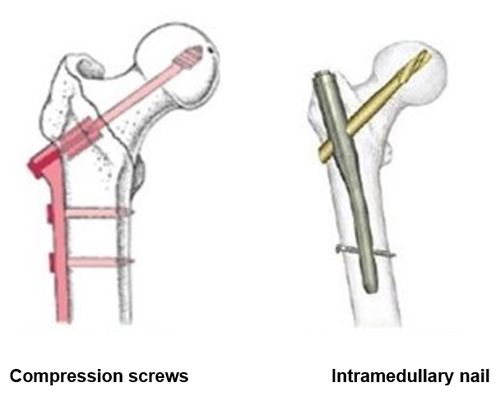 Compression screws and Intramedullary nail