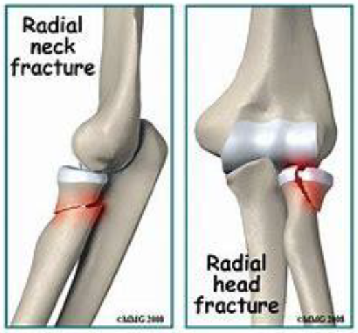 Radial Head Fracture Elbow | Fracture Tête Radiale Traitement – IMCUI