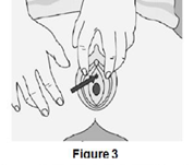 Expose the Urethra
