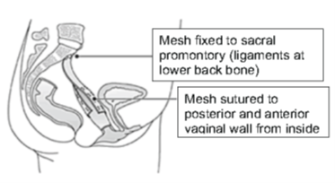 Figure 1: Diagram of sacrocolpopexy