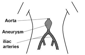 Figure 1: Diagram showing abdominal aortic aneurysm.