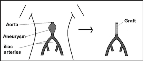 Figure 1: Diagram showing the major blood vessels in the abdomen
