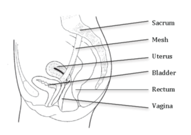 Figure 1: Diagram showing the mesh and pelvis organs