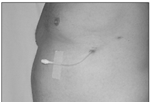 Figure 1: Image of an indwelling pleural catheter