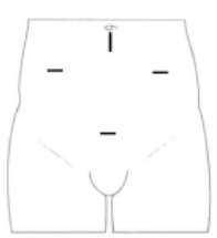 Figure 1: Image of typical incision sites but these may vary.