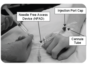 Figure 1: Ported cannula being flushed through. Not all cannulas have an injection port