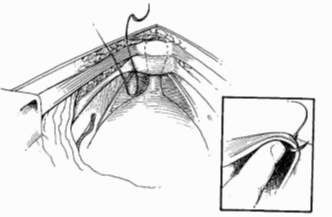 Figure 1: Position of sutures placed during the operation