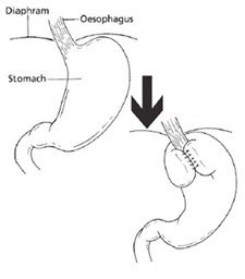Figure 1: The stomach before and after the anti-reflux surgery. The diagram to the right shows the 'Nissen' that is the most popular with the surgeons in our department.