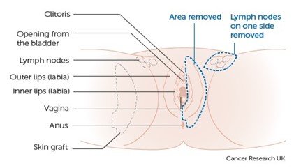 Figure 1 shows a partial vulvectomy where the cancer is on one side of the vulva