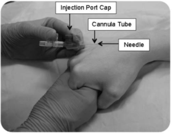 Figure 2: A peripheral intravenous (IV) ported cannula about to be inserted.
