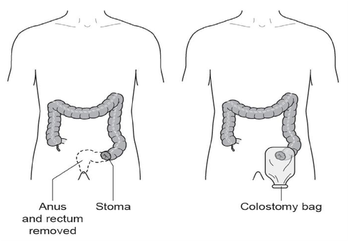 Figure 2: Abdomino Perineal Excision of the Rectum (APER)