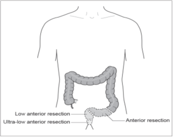 Figure 2: Anterior resection diagram