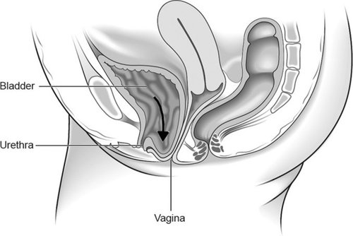 Figure 2: Anterior wall prolapse