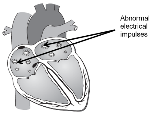 Figure 2: Atrial Fibrillation