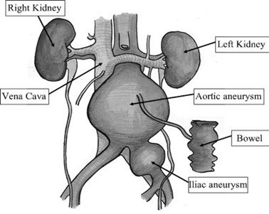 Figure 2: Diagram showing abdominal and iliac aneurysms