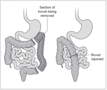 Figure 2: Left hemicolectomy