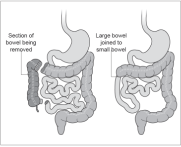 Figure 2: Right hemicolectomy