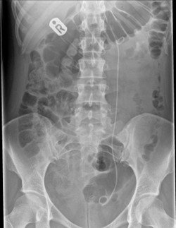 Figure 2: X-ray image of the ureteric stent in place