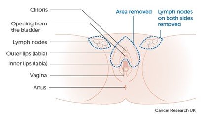 Figure 2 shows a partial vulvectomy where the cancer is at the top of the vulva