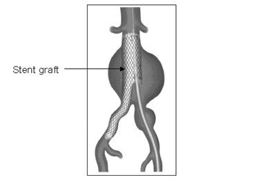 Figure 3: EVAR surgery