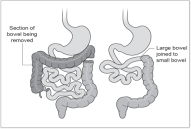 Figure 3: Extended right hemicolectomy