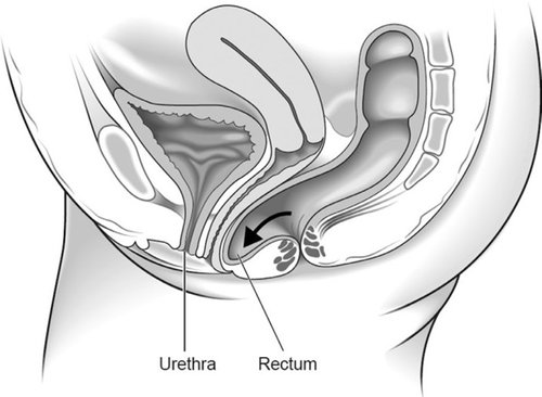 Figure 3: Posterior wall prolapse