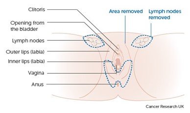 Figure 3 shows a partial vulvectomy where the cancer is in the lower part of the vulva