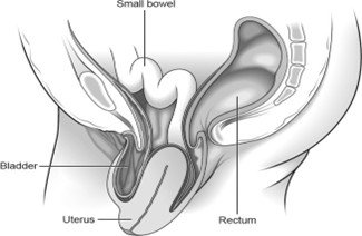 Figure 4: Uterine prolapse
