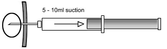 1b fine needle apiration