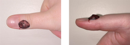 If the area is raised