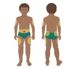 Injection technique guidance