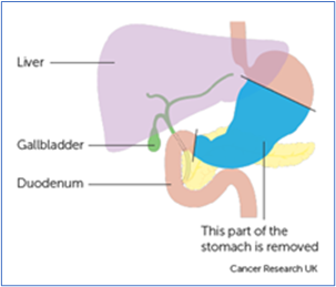 Partial gastrectomy 1