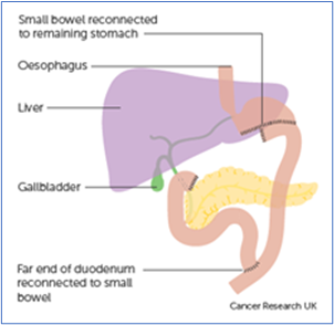 Partial gastrectomy 2