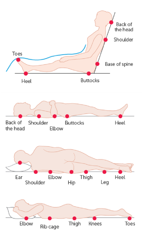 Pressure ulcers can occur anywhere on the body but there are areas where they are more common