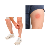 Blood clot - sore leg or arm