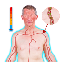 An older man with a high fever, indicated by a red thermometer, and a diagram of his circulatory system.