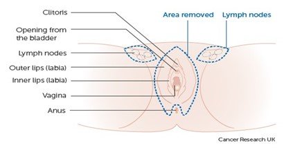 Surgery to remove the whole vulva