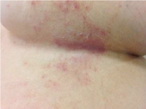 Symptoms of intertrigo