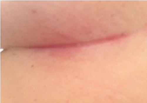 The growth of yeast which appears as a rash in the skin fold under the