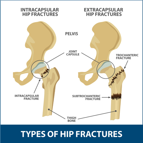 Types of hip fractures