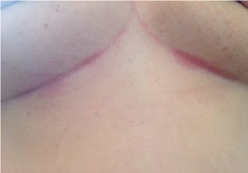 Under-breast soreness (UBS)