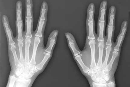 bone-xray-hands.jpg
